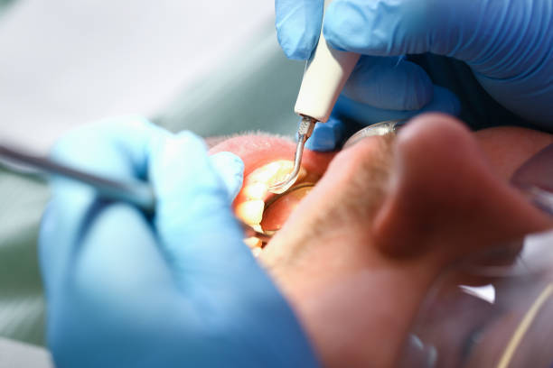 Best Emergency Tooth Extraction in Rosaryville, MD
