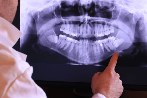 Best Emergency Wisdom Teeth Removal in Rosaryville, MD