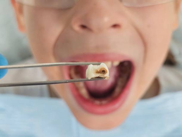Best Emergency Tooth Extraction in Rosaryville, MD